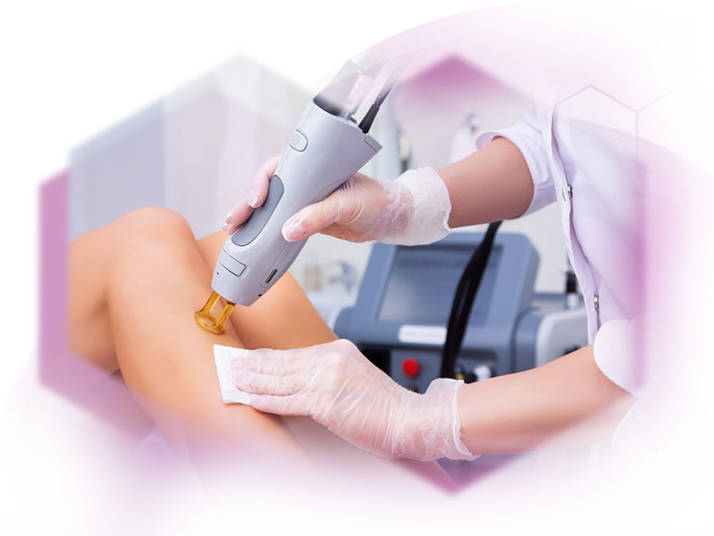 Photo Treatment with Alexandritlaser woman leg