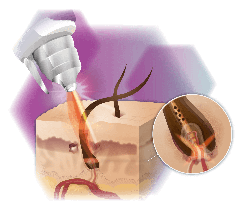 Illustration der Wirkung des ND:YAG-Lasers auf die Haare bei der Behandlung