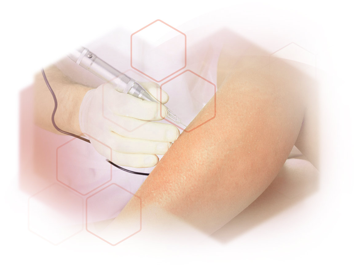 treatment picture needle epilation