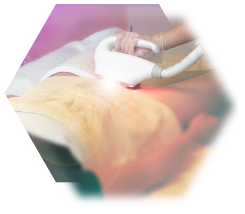 Treatment photoepilation intimate zone