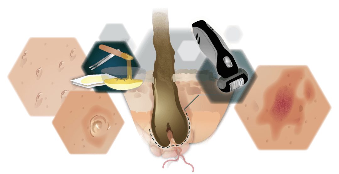 Infografik Waxing sugaring epilieren