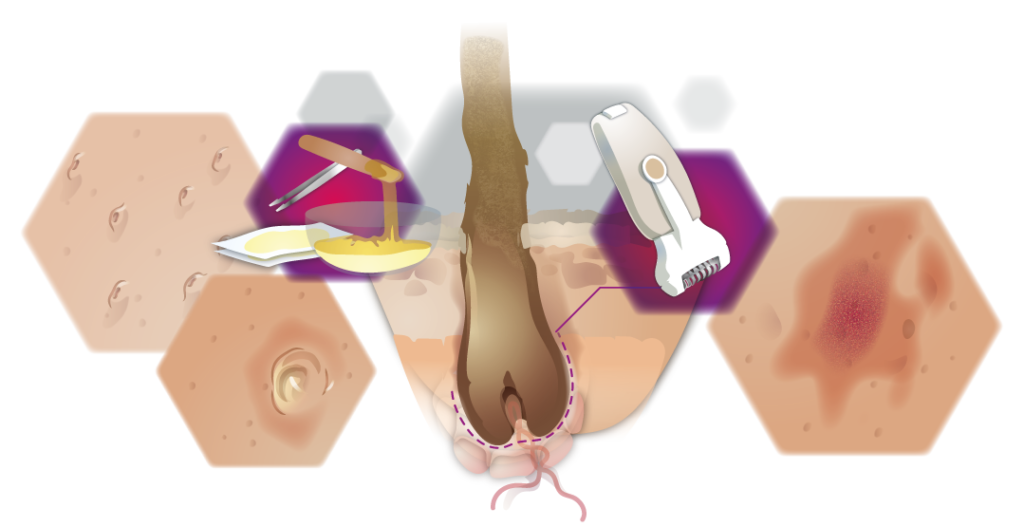 Infografik Wirkungsweise Tiefe von Waxing Sugaring und Epilieren