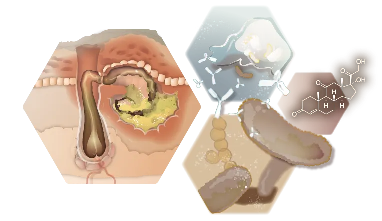 Infographie Bactéries abcès et cortisone