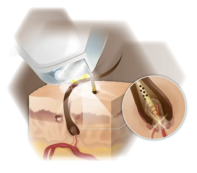Grafik eines IPL Handstücks und der Wirkung des Lichts auf ein Haar und die Haut bei der IPL-Haarentfernung