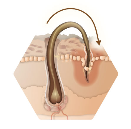Infographie cheveux du canal capillaire