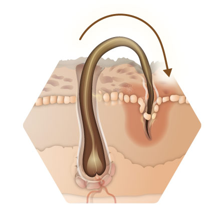 Infografik eingewachsenes Haar Variante Haar wächst erneut in die Haut ein