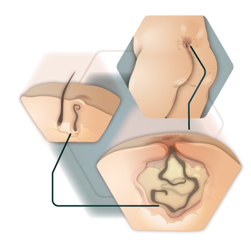 Infographie Développement de la fistule cervicale