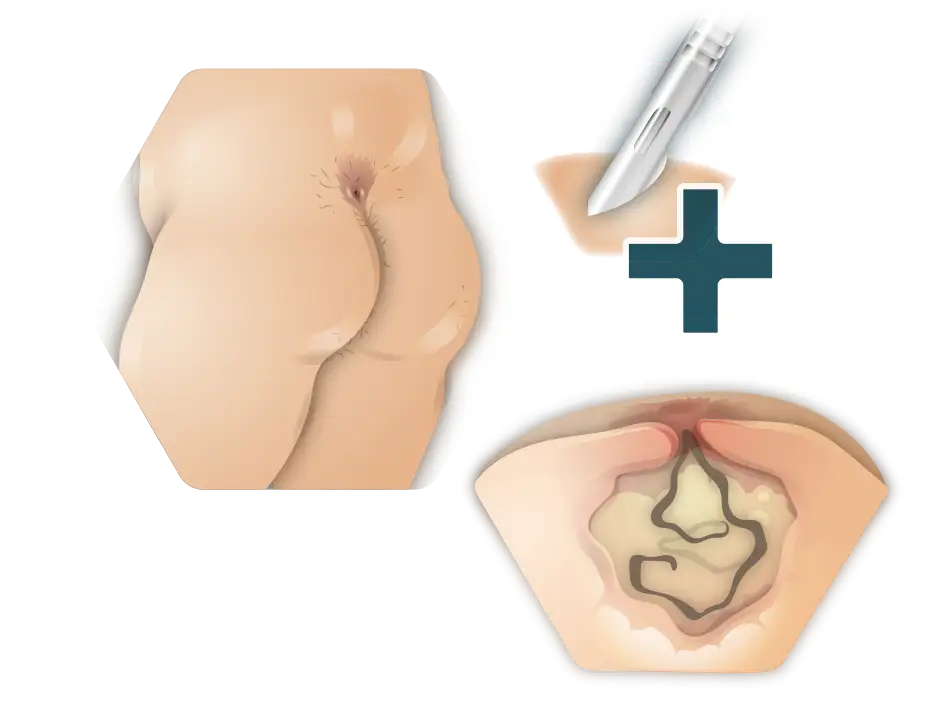 Infographic coccyx fistua