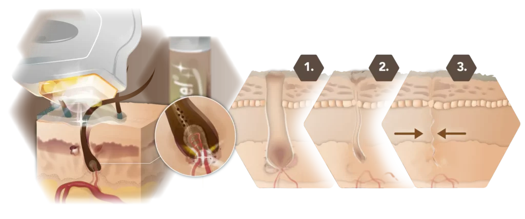Infographie sur la prévention des poils incarnés avec la technologie XENOgel®