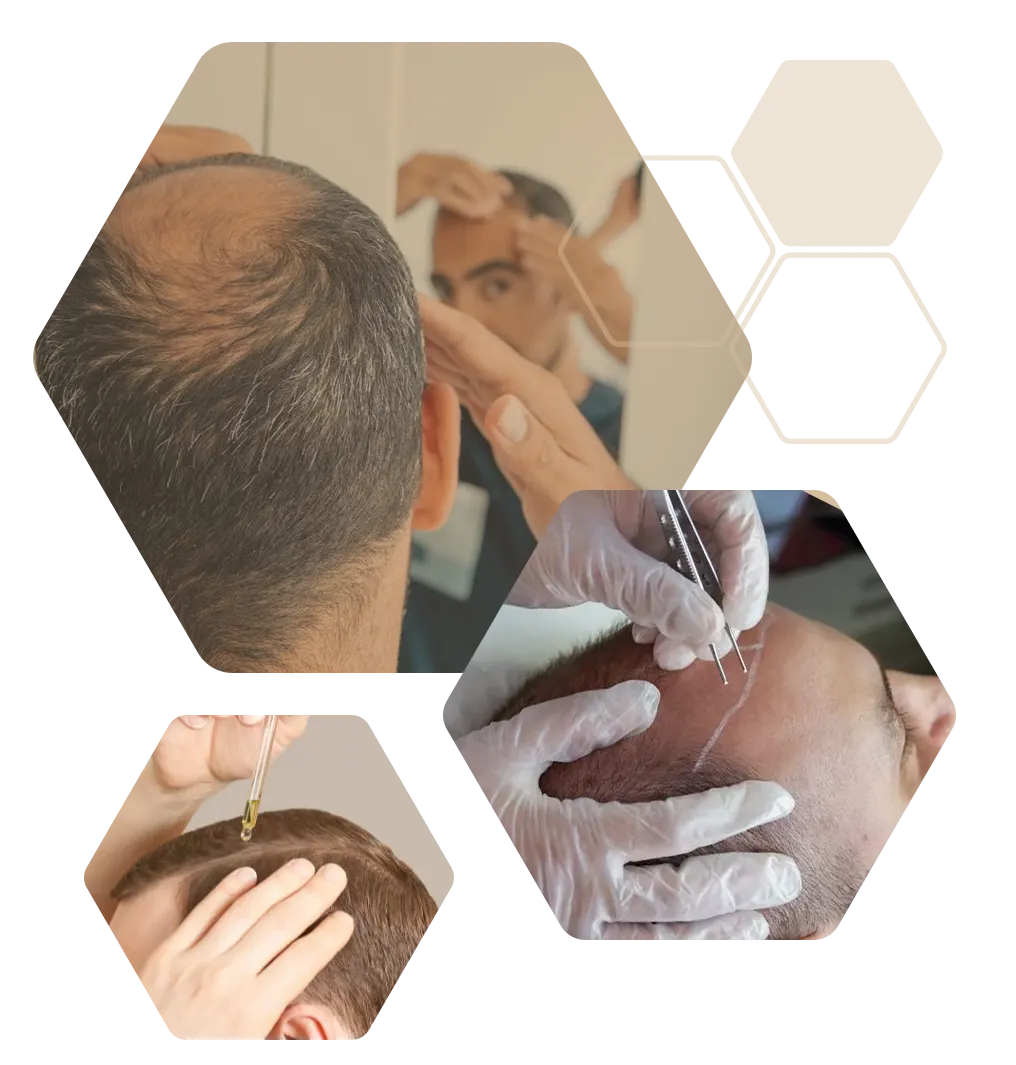 Mann Behandlungsmöglichkeiten Glatze Haarausfall kahle Stellen am Kopf